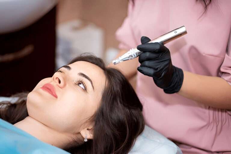 How Long Is the Recovery Time After a Hair Transplant in London?
