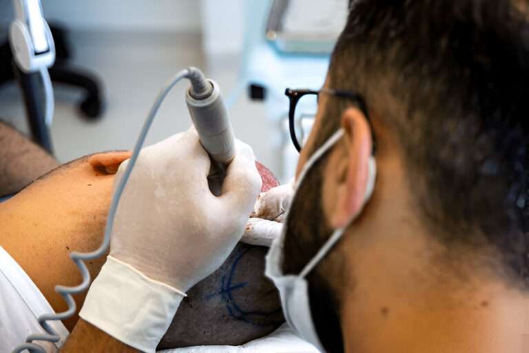 Hair Transplant Consultations: What to Expect in London