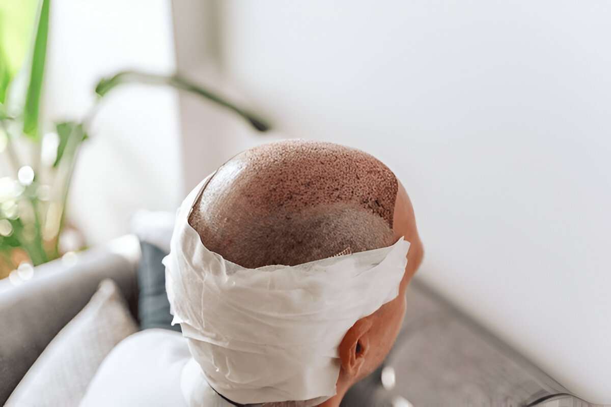 Hair Transplant