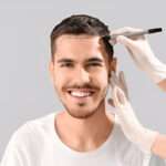 Why Men in London Are Turning to Hair Transplants