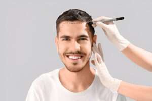 Hair transplant London