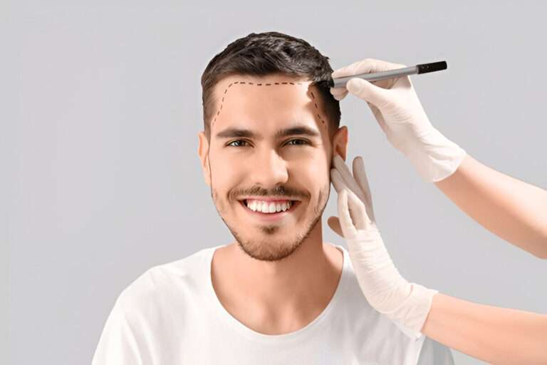 Why Men in London Are Turning to Hair Transplants