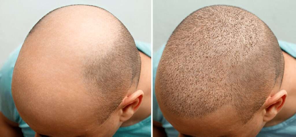 The Benefits of Choosing a UK Clinic for Your Hair Transplant