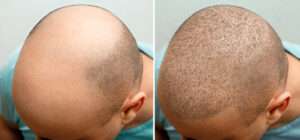 hair transplant Cardiff