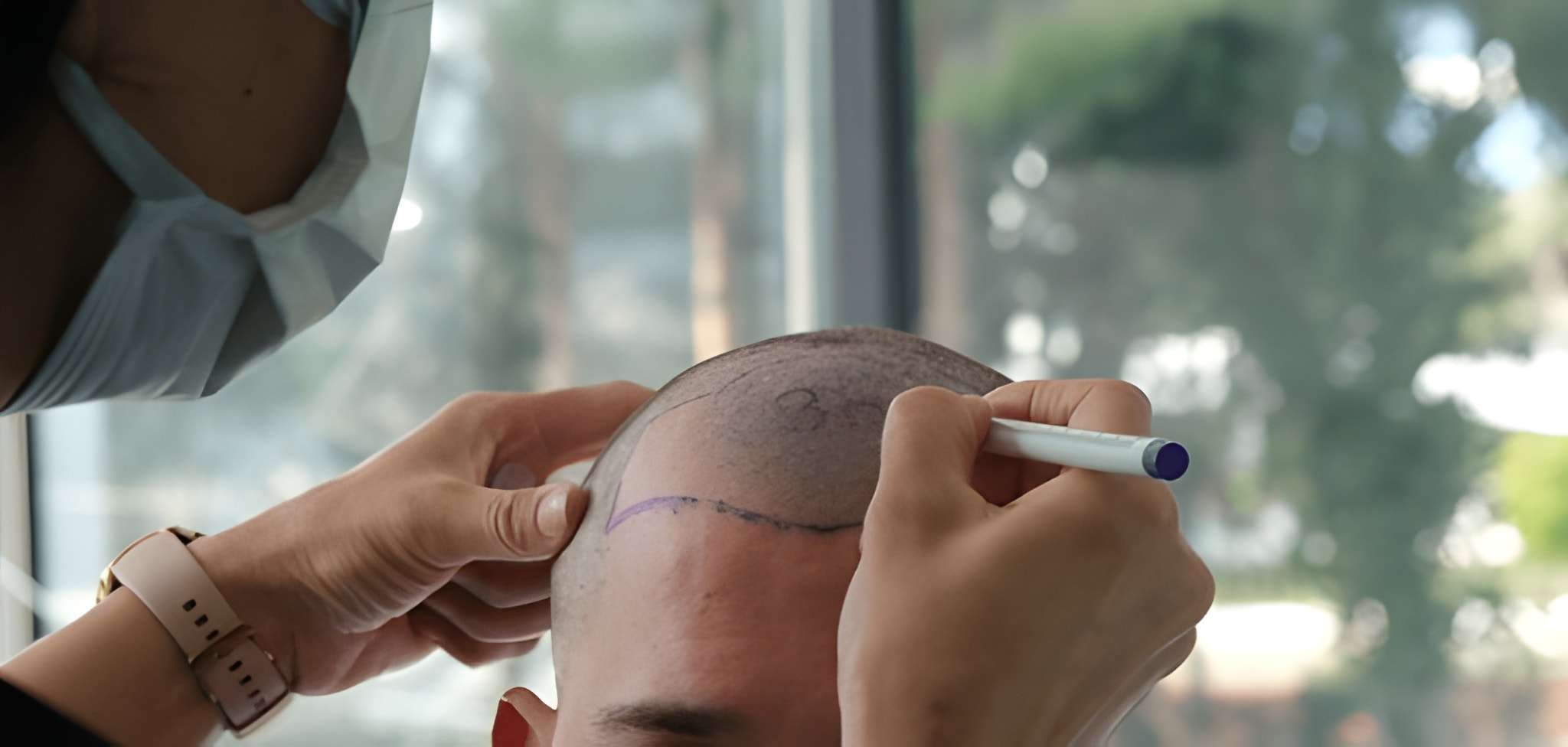 Hair Transplant