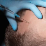 How to Avoid Hair Transplant Failures: Key Tips
