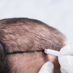 The Top 5 Myths About Hair Transplants You Should Stop Believing