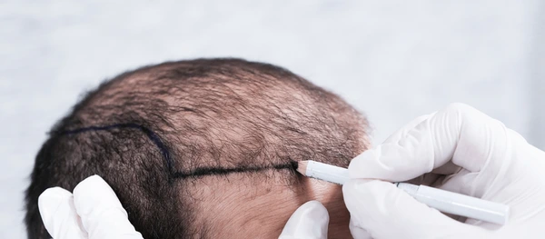The Top 5 Myths About Hair Transplants You Should Stop Believing