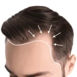 What to Expect During Hair Loss Treatment