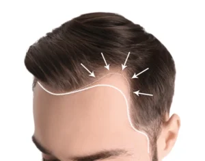 hair loss treatment
