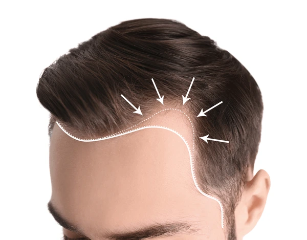 What to Expect During Hair Loss Treatment