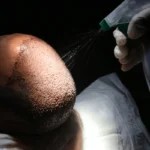 Smart Steps for Your Hair Transplant Treatment