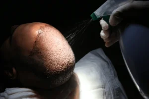 best age for hair transplant
