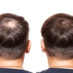 Finding Your Ideal Hair Loss Treatment